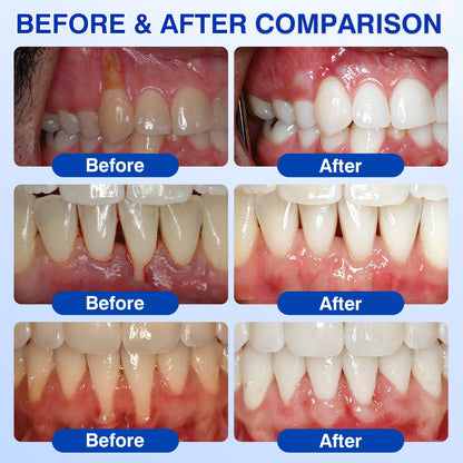 🇺🇸🏅🦷Evolvion® 9D White Remineralizing Hydroxyapatite Tooth Powder, 🛡️Deep Cleaning, Fresh Breath, Ideal for Oral Health & Hygiene Gift for Women Men